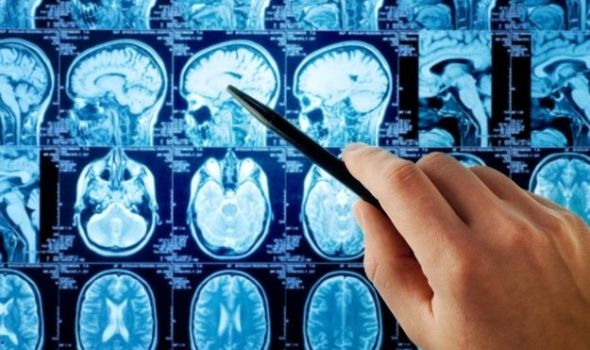 Trombektomija: Novi način lečenja moždanog udara i u Kragujevcu, pacijenti sa manje od 30 godina!